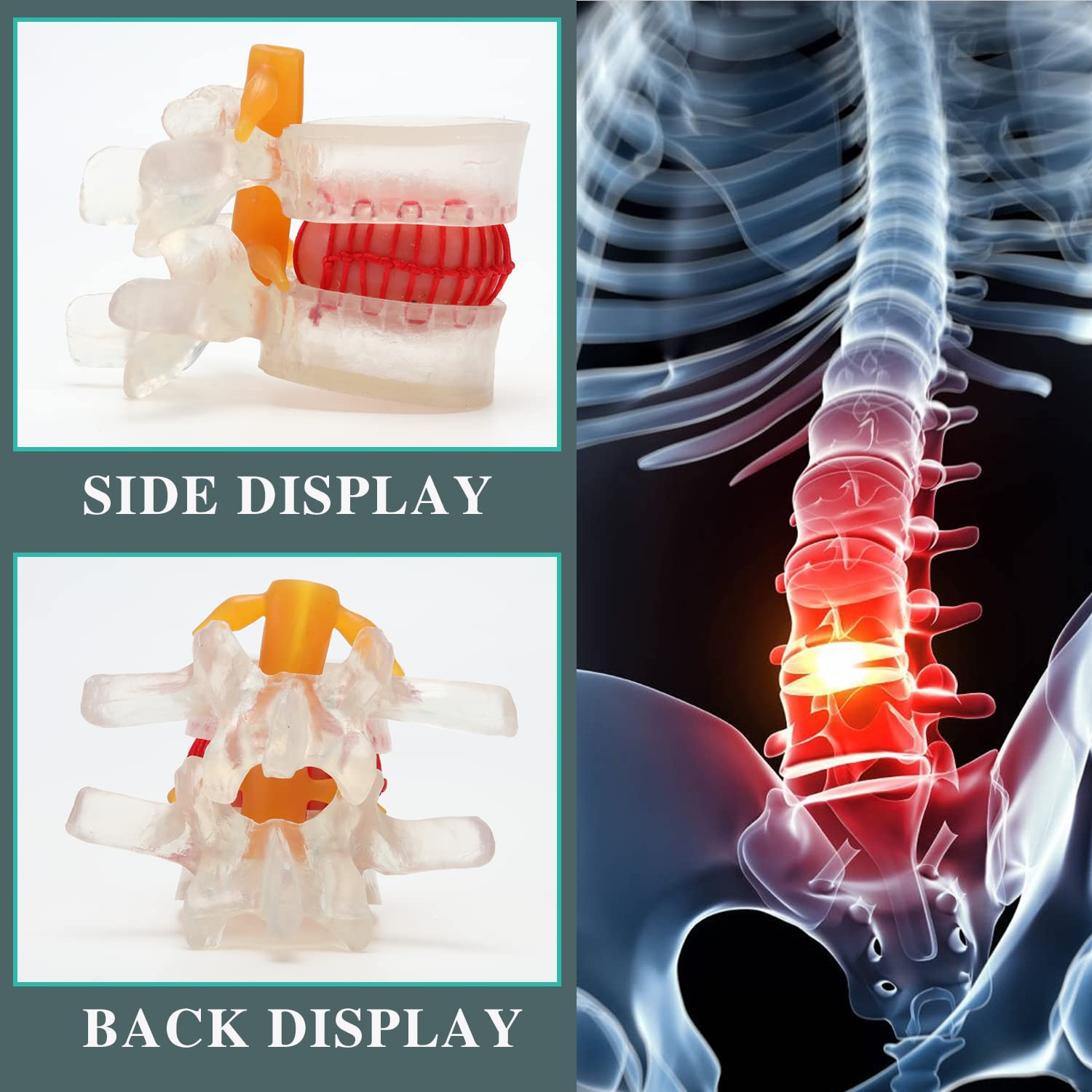 Human Lumbar Disc Herniation Model Transparent Lumbar Spine Model Display