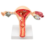 RONTEN Human Uterus and Ovary Model Pathological Uterus Anatomical Model