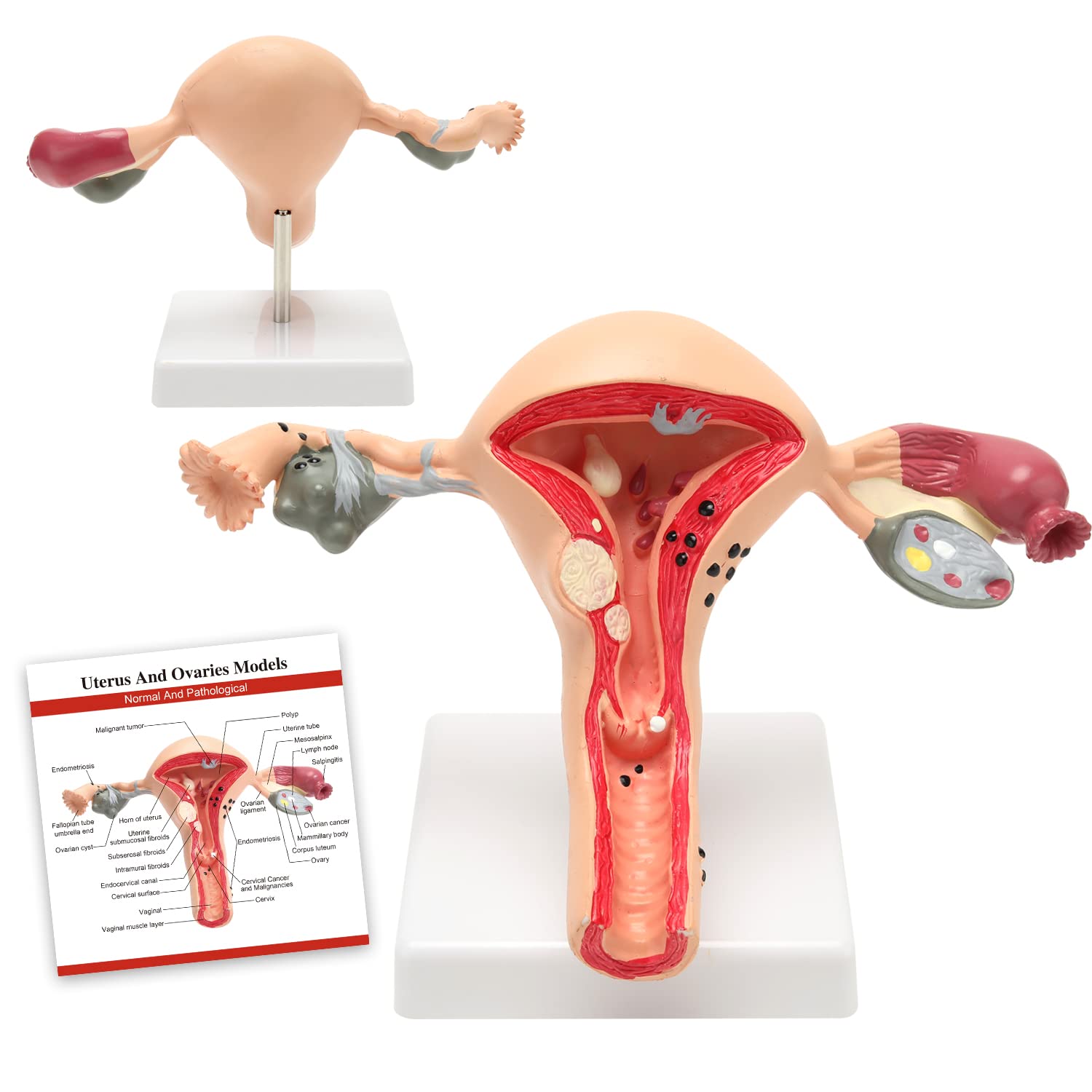 RONTEN Human Uterus and Ovary Model Pathological Uterus